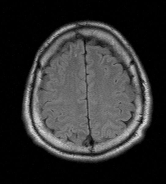 File:Cerebellopontine angle meningioma (Radiopaedia 24459-24764 Axial FLAIR 20).jpg