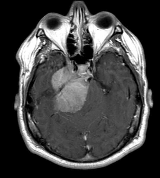 File:Cerebellopontine angle meningioma (Radiopaedia 24459-24764 Axial T1 C+ 8).jpg