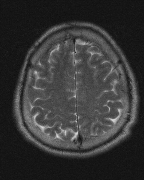 File:Cerebellopontine angle meningioma (Radiopaedia 24459-24764 Axial T2 19).jpg