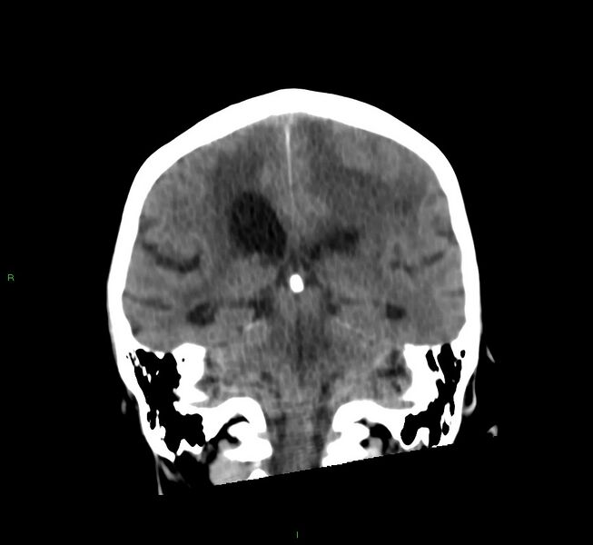 File:Cerebral amyloid angiopathy-associated lobar intracerebral hemorrhage (Radiopaedia 58530-65688 Coronal non-contrast 29).jpg