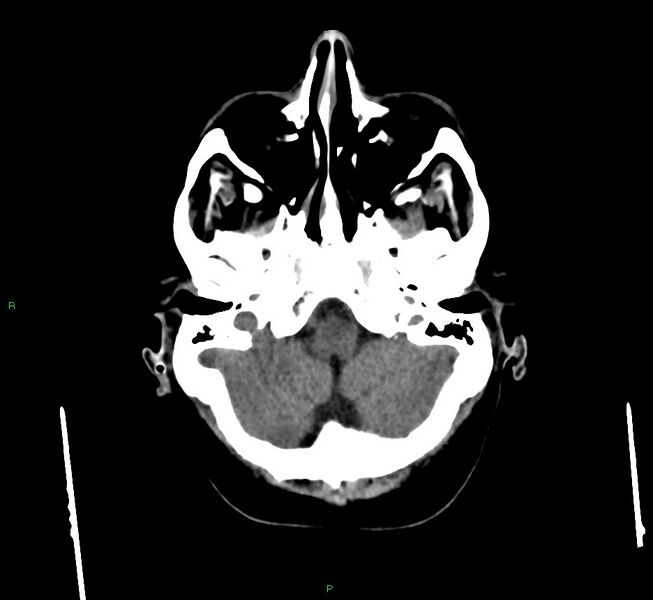 File:Cerebral amyloid angiopathy-associated lobar intracerebral hemorrhage (Radiopaedia 58560-65723 Axial non-contrast 44).jpg