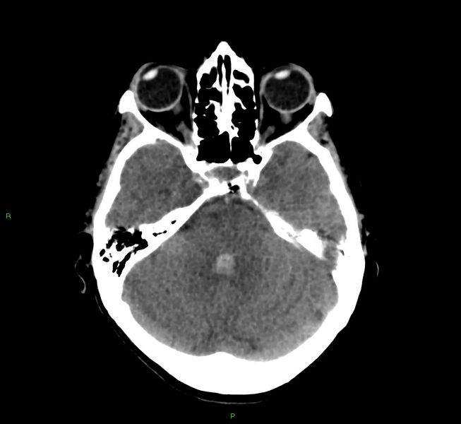 File:Cerebral amyloid angiopathy-associated lobar intracerebral hemorrhage (Radiopaedia 58566-65730 Axial non-contrast 36).jpg
