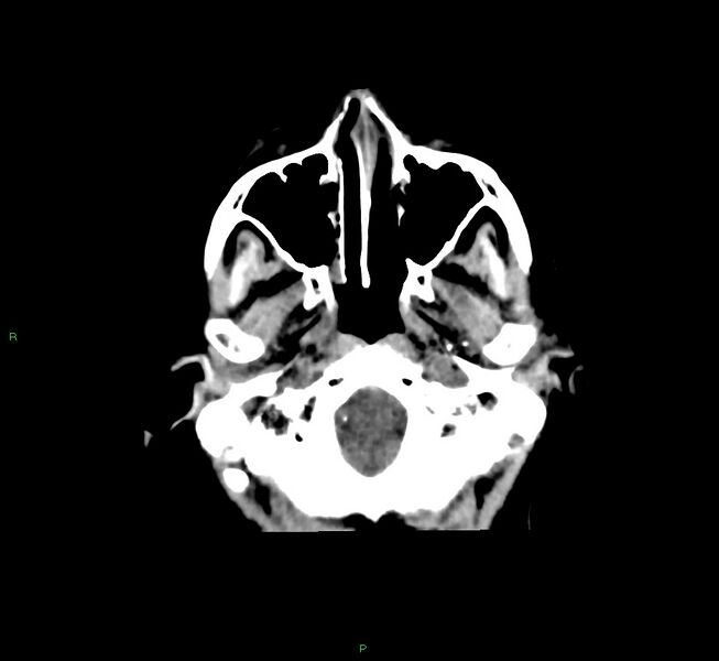 File:Cerebral amyloid angiopathy-associated lobar intracerebral hemorrhage (Radiopaedia 58751-65972 Axial non-contrast 45).jpg