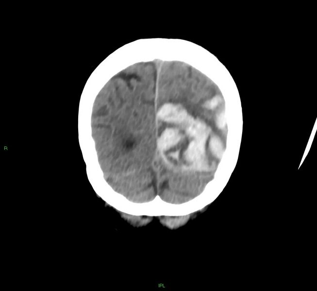 File:Cerebral amyloid angiopathy-associated lobar intracerebral hemorrhage (Radiopaedia 58754-65975 Coronal non-contrast 13).jpg