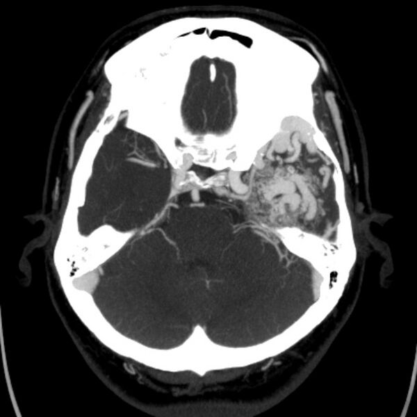 File:Cerebral arteriovenous malformation (Radiopaedia 43729-47189 B 15).jpg