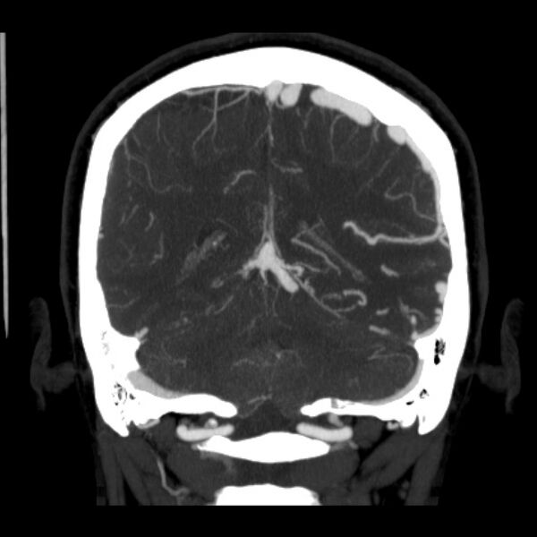 File:Cerebral arteriovenous malformation (Radiopaedia 43729-47189 C 33).jpg