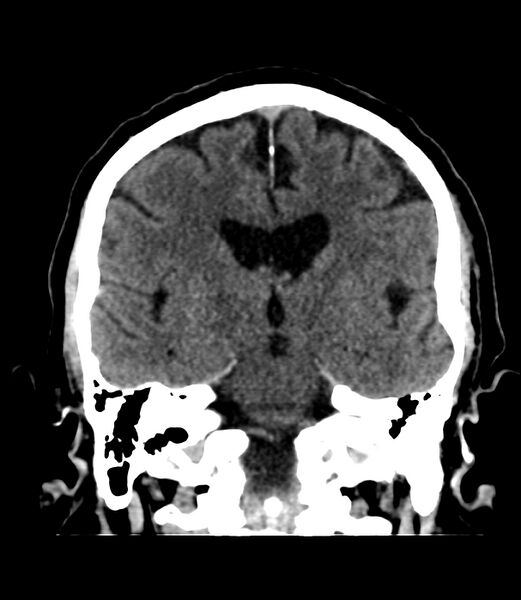 File:Cerebral dural venous sinus thrombosis (Radiopaedia 86514-102575 Coronal non-contrast 25).jpg