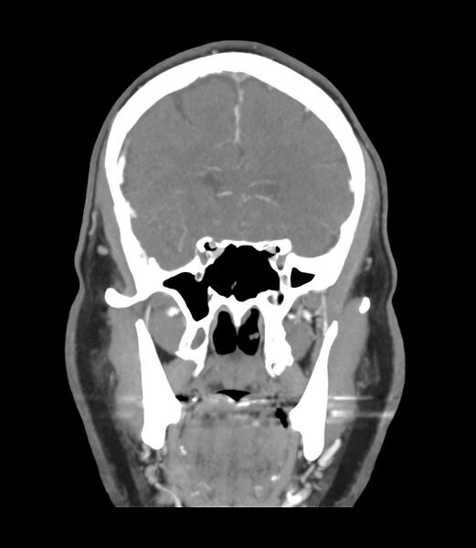 File:Cerebral dural venous sinus thrombosis (Radiopaedia 86514-102576 B 19).jpg
