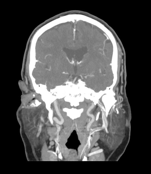 File:Cerebral dural venous sinus thrombosis (Radiopaedia 86514-102576 B 31).jpg
