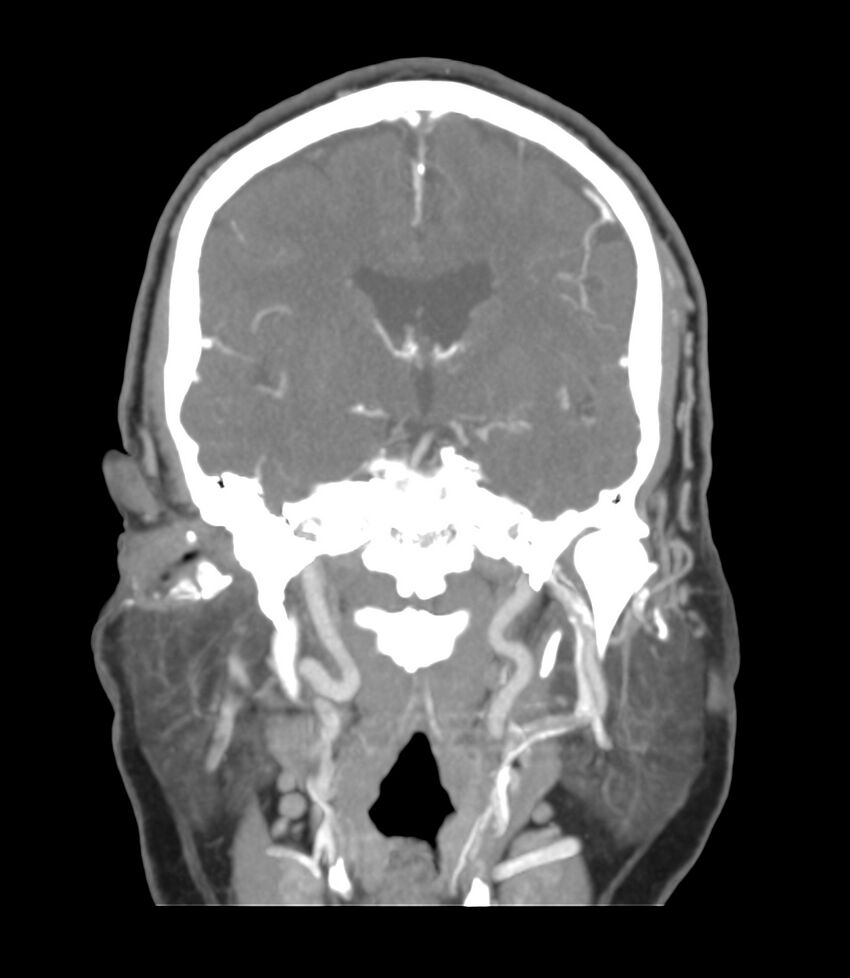 Cerebral dural venous sinus thrombosis (Radiopaedia 86514-102576 B 31).jpg