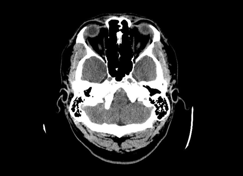 Cerebral edema (Radiopaedia 82519-96661 Axial non-contrast 45).jpg