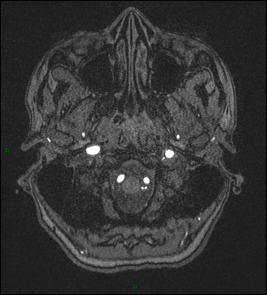 File:Cerebral fat embolism (Radiopaedia 35022-36525 Axial TOF 11).jpg