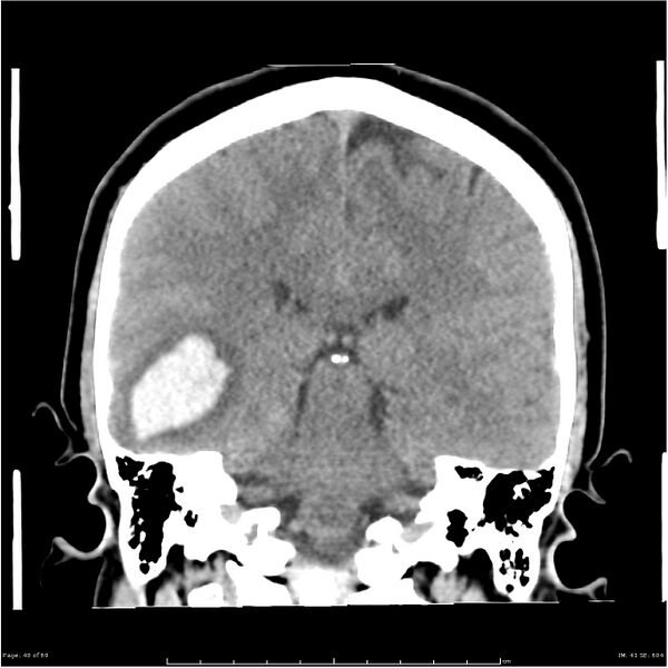 File:Cerebral hemorrhage secondary to arteriovenous malformation (Radiopaedia 33497-34561 Coronal non-contrast 31).jpg