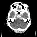 Cerebral hemorrhagic contusions (Radiopaedia 23145-23188 Axial non-contrast 8).jpg