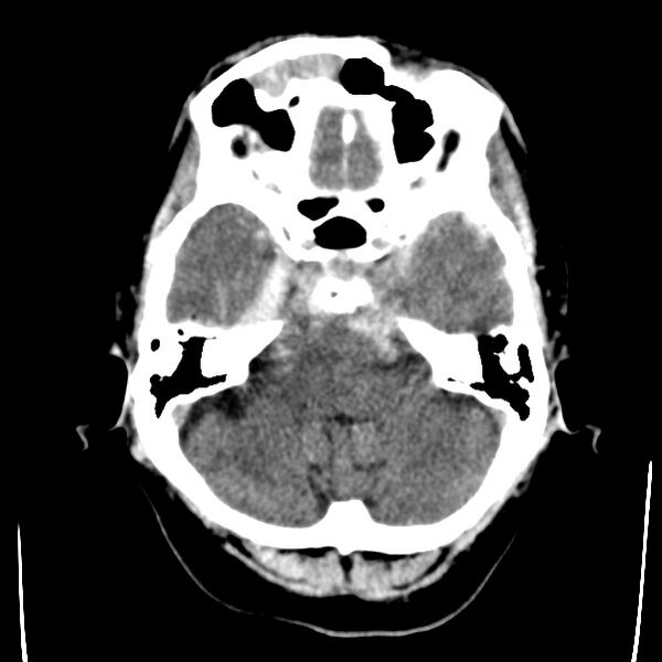 File:Cerebral hemorrhagic contusions (Radiopaedia 23145-23188 Axial non-contrast 8).jpg