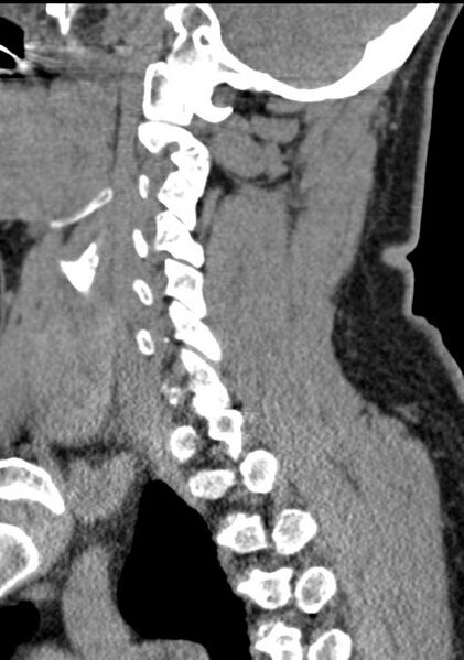 File:Cerebral hemorrhagic contusions and cervical spine fractures (Radiopaedia 32865-33841 G 72).jpg