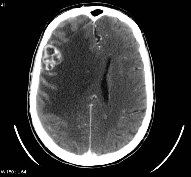 File:Cerebral metastasis - lung cancer (Radiopaedia 6066).jpg