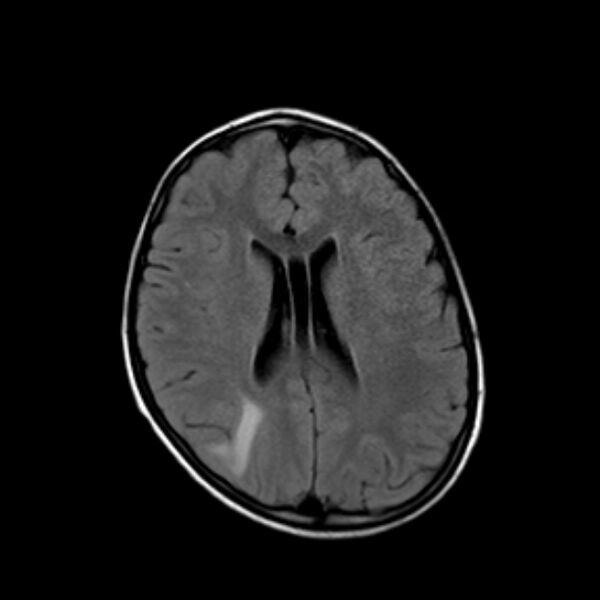 File:Cerebral tuberculoma (Radiopaedia 41152-43932 Axial FLAIR 14).jpg
