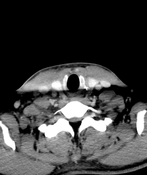File:Cervical abscess (Radiopaedia 43725-47184 A 53).png