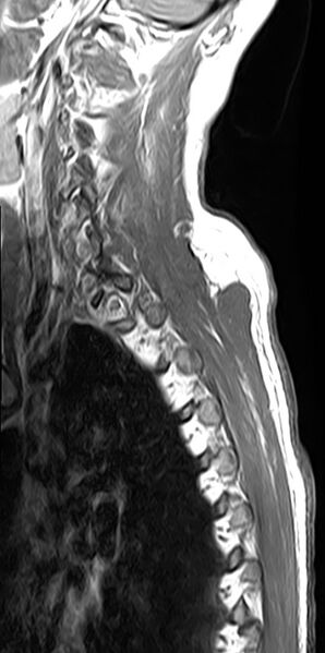 File:Cervical compressive myelopathy (Radiopaedia 71956-82411 Sagittal T1 C+ 2).jpg