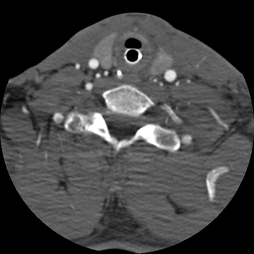 Cervical spine fractures with vertebral artery dissection (Radiopaedia 32135-33078 D 27).jpg