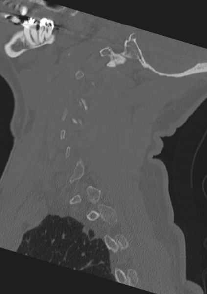 File:Cervical spine fractures with vertebral artery dissection (Radiopaedia 53296-59268 Sagittal bone window 54).png