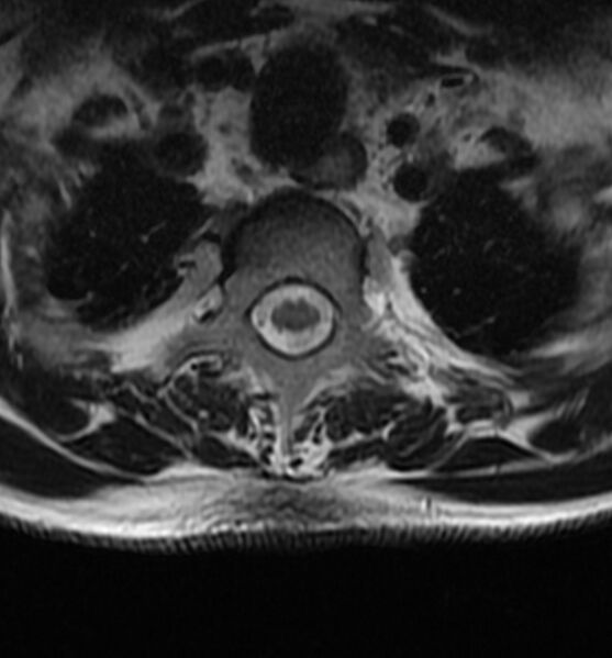 File:Cervical spondylodiscitis (Radiopaedia 81362-95110 Axial T2 22).jpg