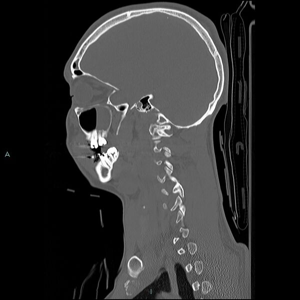 File:Cervical vertebral burst fracture (Radiopaedia 37420-39258 Sagittal bone window 3).jpg