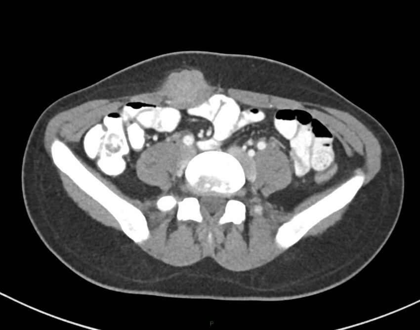Cesarean scar endometriosis (Radiopaedia 82925-97262 A 56).jpg
