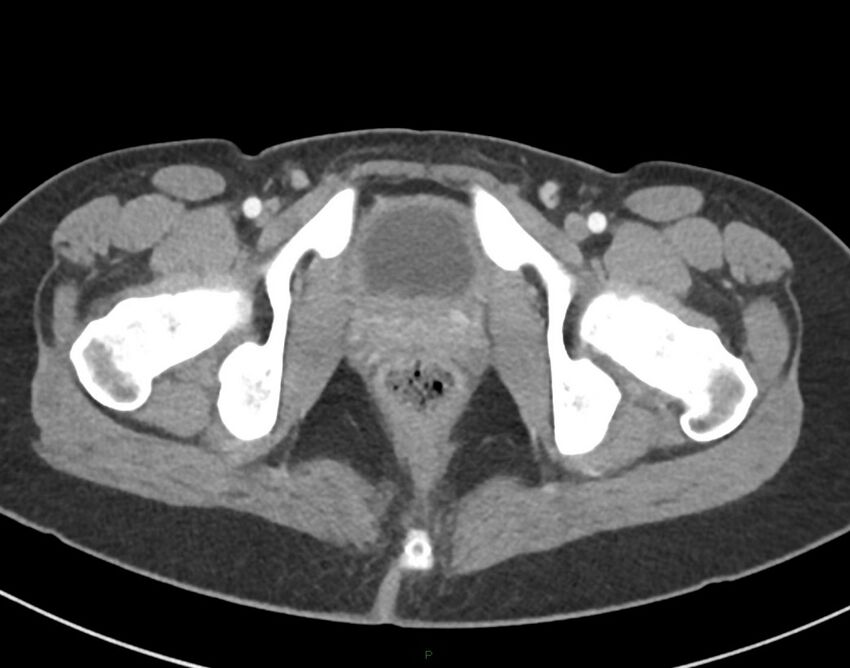 Cesarean scar endometriosis (Radiopaedia 82925-97262 A 86).jpg