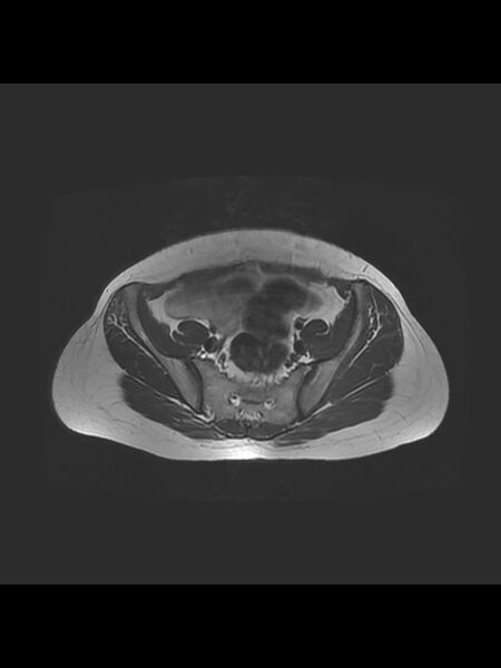 File:Cesarean section scar endometrioma (Radiopaedia 56569-63297 Axial T2 7).jpg