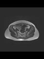 Cesarean section scar endometrioma (Radiopaedia 56569-63297 Axial T2 7).jpg