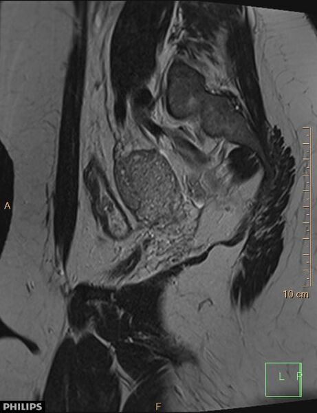 File:Cesarian scar endometriosis (Radiopaedia 68495-78066 Sagittal T2 21).jpg