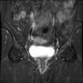 Cesarian section scar endometriosis (Radiopaedia 66520-75799 Coronal STIR 14).jpg