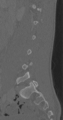Chance fracture (Radiopaedia 40360-42912 Sagittal bone window 66).png