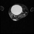 Chiari II malformation with spinal meningomyelocele (Radiopaedia 23550-23652 Axial T2 13).jpg