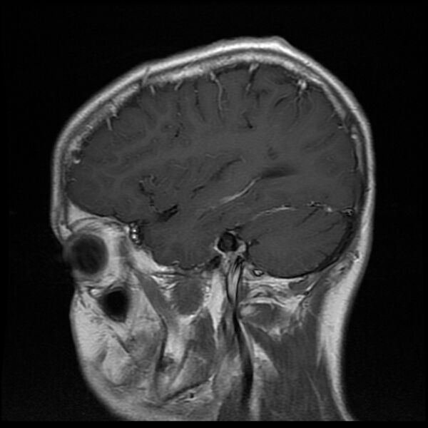 File:Chiasmatic-hypothalamic juvenile pilocytic astrocytoma (Radiopaedia 78533-91236 Sagittal T1 C+ 7).jpg