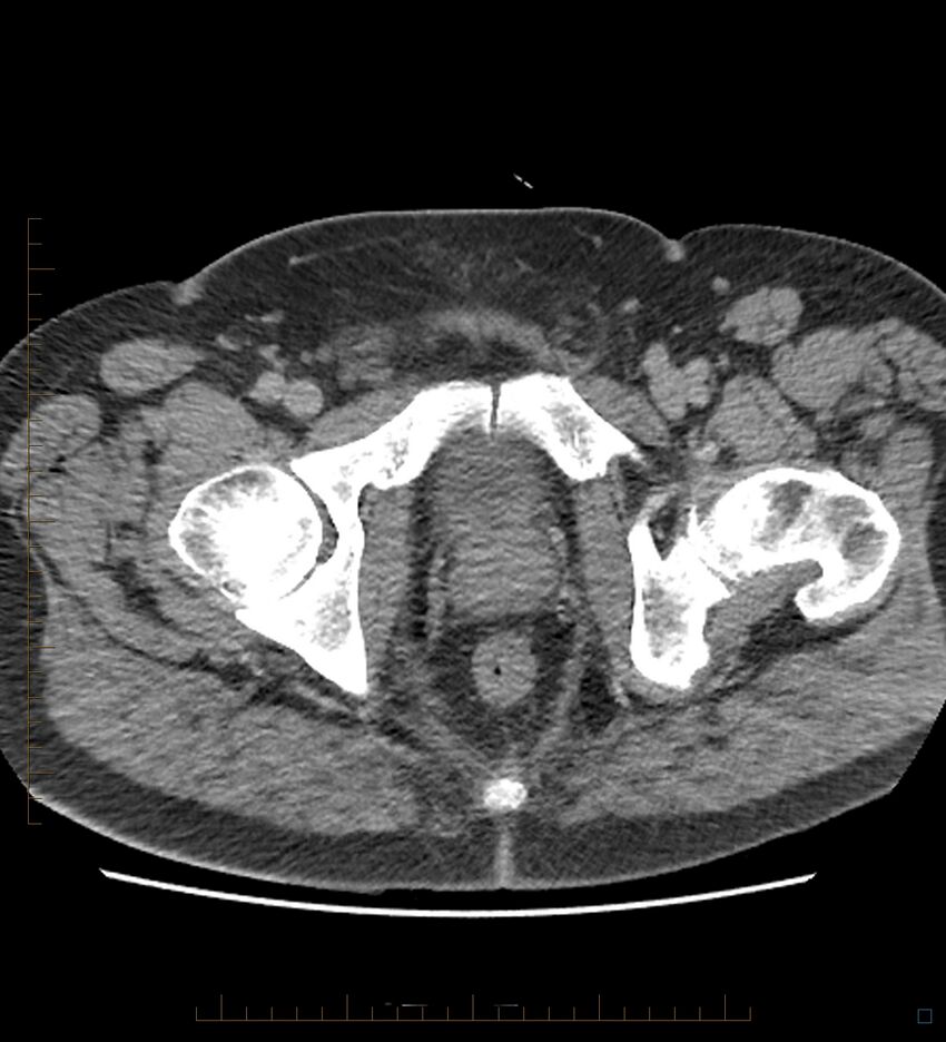 Chicken bone in anal canal (Radiopaedia 51490-57253 Axial non-contrast 8).jpg