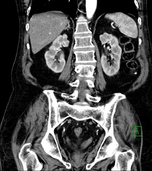 File:Cholangiocarcinoma with cerebral metastases (Radiopaedia 83519-98629 E 60).jpg