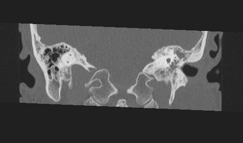 File:Cholesteatoma (Radiopaedia 10742-11203 Coronal bone window 17).jpg
