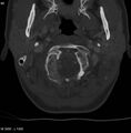Chondroblastoma - occipital condyle (Radiopaedia 5569-7304 bone window 9).jpg