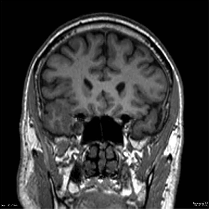 Chondrosarcoma of skull base- grade II (Radiopaedia 40948-43654 Coronal T1 51).jpg