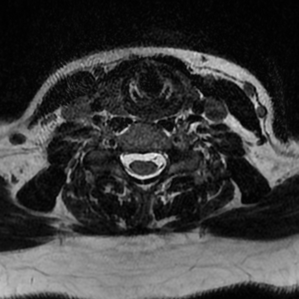 File:Chordoma - cervical spine (Radiopaedia 70084-80111 Axial T2 63).png
