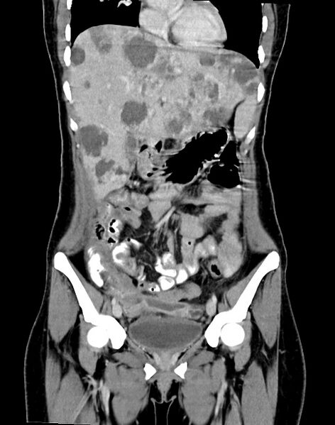 File:Choriocarcinoma liver metastases (Radiopaedia 74768-85766 B 42).jpg