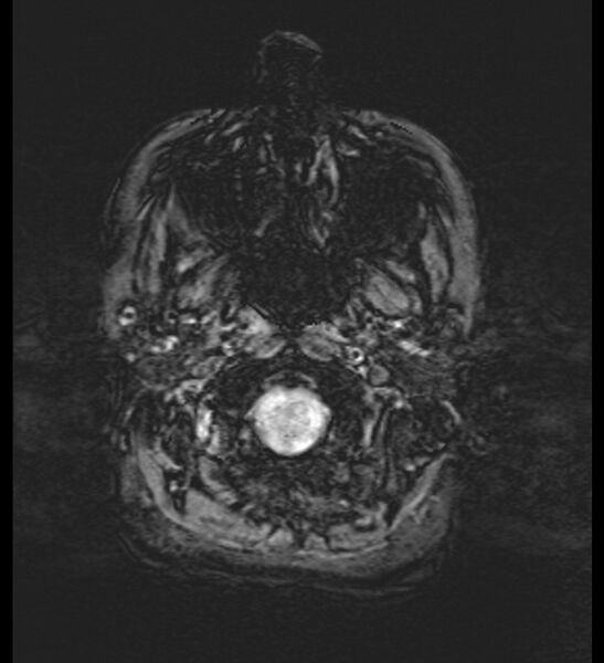 File:Choroid plexus xanthogranuloma (Radiopaedia 91271-108875 Axial SWI 5).jpg