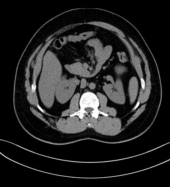 File:Chromophobe renal cell carcinoma (Radiopaedia 84286-99573 Axial non-contrast 20).jpg