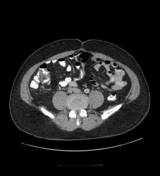 File:Chromophobe renal cell carcinoma (Radiopaedia 84337-99644 C 85).jpg
