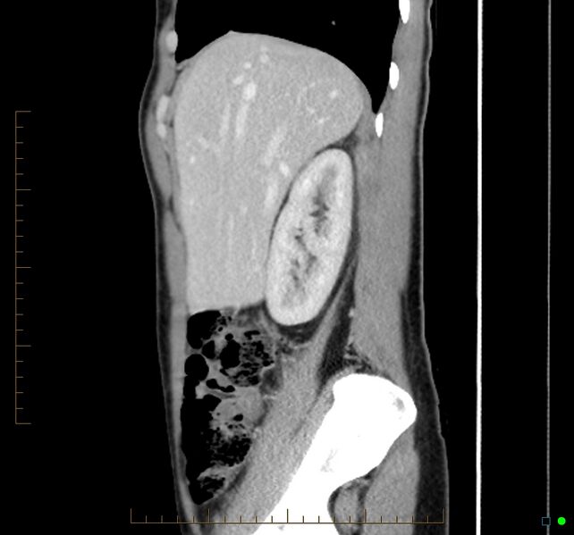 File:Chronic abscess due to "dropped" appendicoliths following appendectomy for perforated appendix (Radiopaedia 58805-66344 D 41).jpg