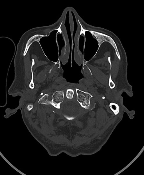 File:Chronic bilateral subdural hygroma (Radiopaedia 85801-101623 Axial bone window 111).jpg