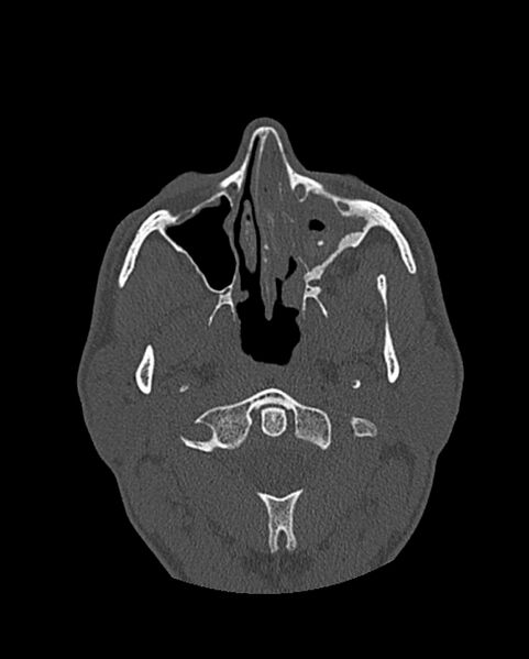 File:Chronic maxillary sinusitis caused by a foreign body (Radiopaedia 58521-65676 Axial bone window 133).jpg